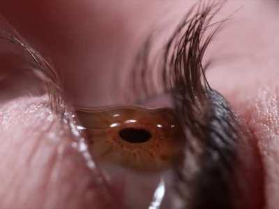 Thanks I hate eye drops now