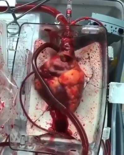 Crazy video of a beating heart awaiting transplant