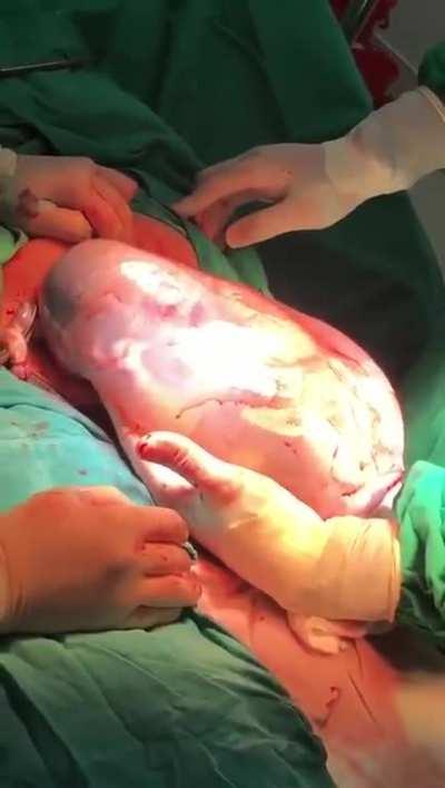 A baby (whose mother is COVID positive) being delivered through C-section by keeping the amniotic sac intact
