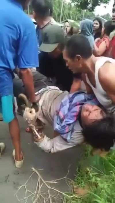 Mans arm burned cleaned to the bone after power line accident