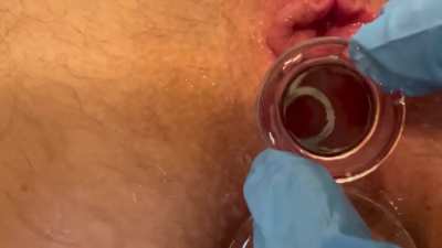 Glass Rod shows off Bladder Sphincter