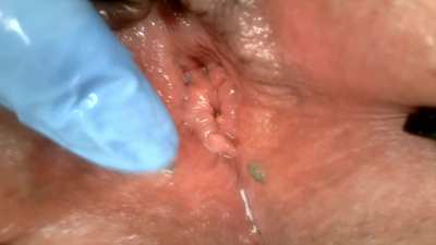 bladder gelatin egg insertion & endoscopy