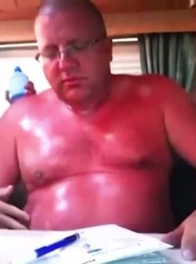 Worst sunburn I’ve ever seen Xpost r/GIFtedIndividuals