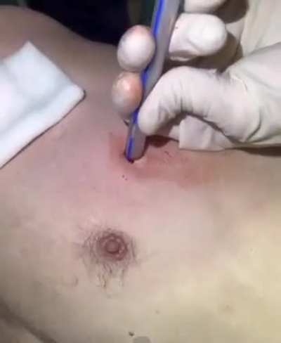(REUPLOAD) Couldn’t find the original so uploading the copy I have. Ukraine Chest seals and chest tube insertion.