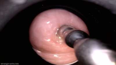 cervix wrinkled orgasms