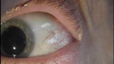 Subconjunctival eye lash removal