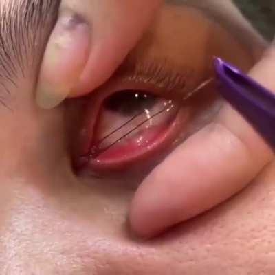 It seems like it's a hair in one eye.