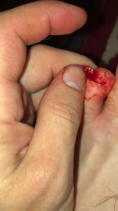 Broken toe nail