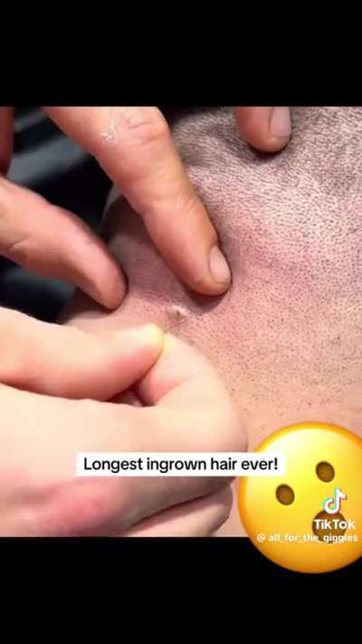 Ingrown Hair