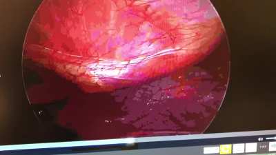 Inside look of chest cavity before surgery