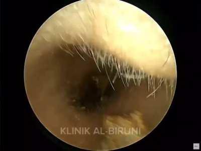 Mesmerizing ear wax removal. 