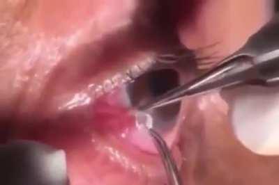 Extracting an African Eye Worm