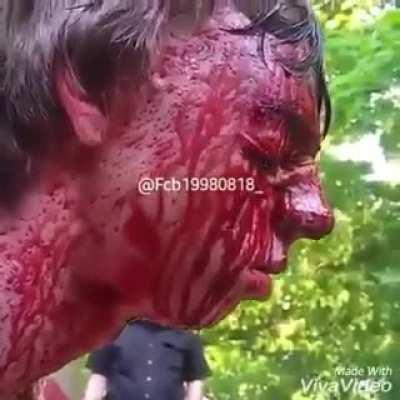 Man ruptures an artery in his face (I think)