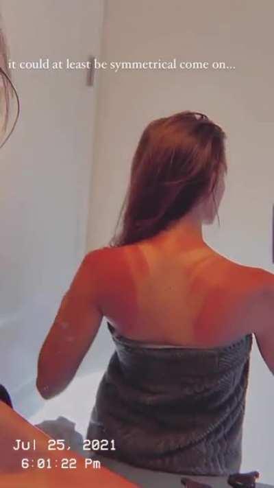 Sunburn