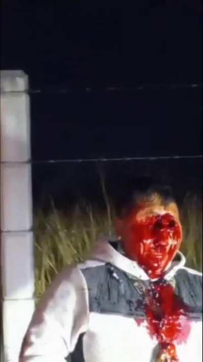 Mexican man lost both of his eyes in an accident.