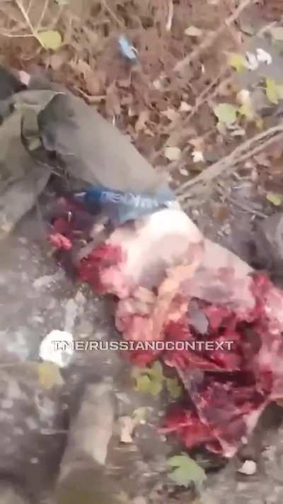 A russian picked up an unexploded drone. It did not stay unexploded. Now we can see his liver, but cannot about half of him.