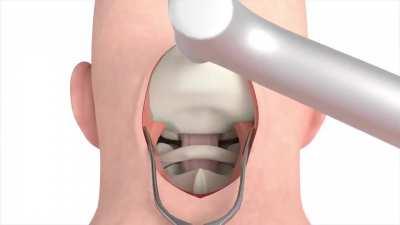 How a craniectomy is performed to remove a tumor.