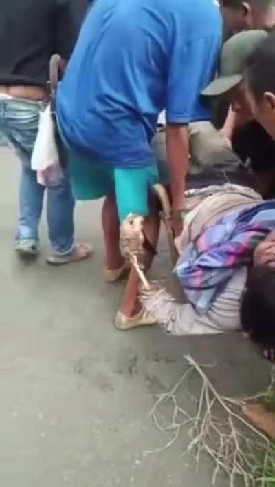 NSFW Arm burned to the bone from touching power line