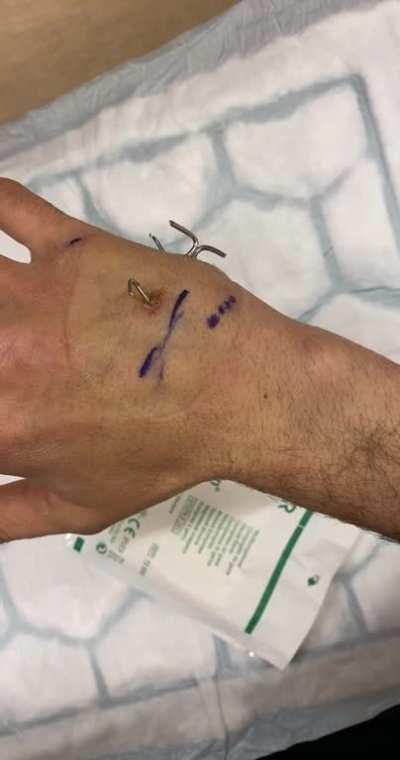 Well, this sucks even more. I’ve apparently broke my broken hand