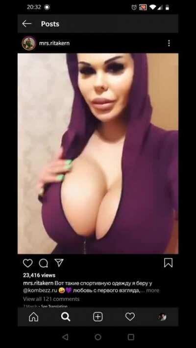 @mra.ritakern Rita Kern, 1,850cc saline breast implants.