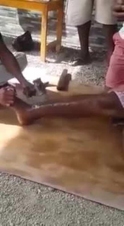 Broke Your Leg? No Worries I Can Fix That