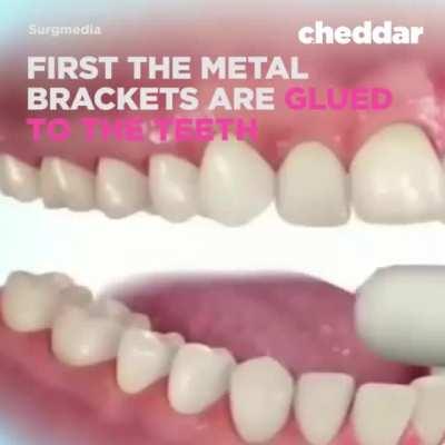 Have you had braces? This is how they are applied. 😬