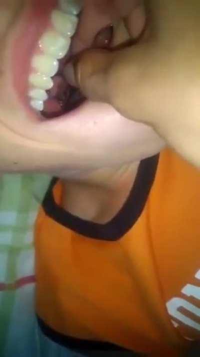 Removing tonsil stones