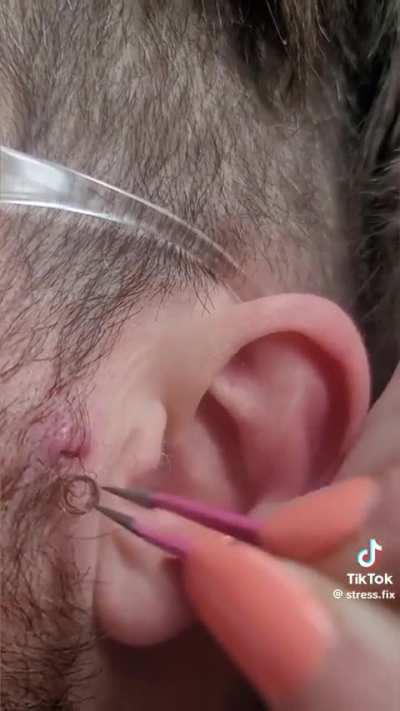 Weird ingrown