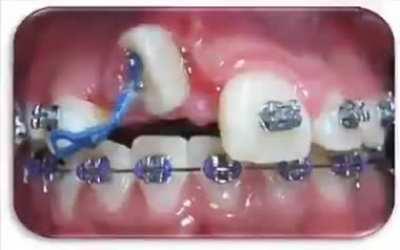 A time lapse of braces straightening teeth
