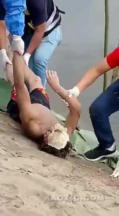 Man with exposed skull taken out of the water 