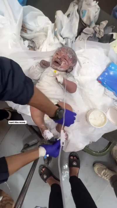 🚨 Israel Targets Babies! This Palestinian baby is suffering from severe burns after surviving a deadly Israeli airstrike that targeted his home in #Gaza.