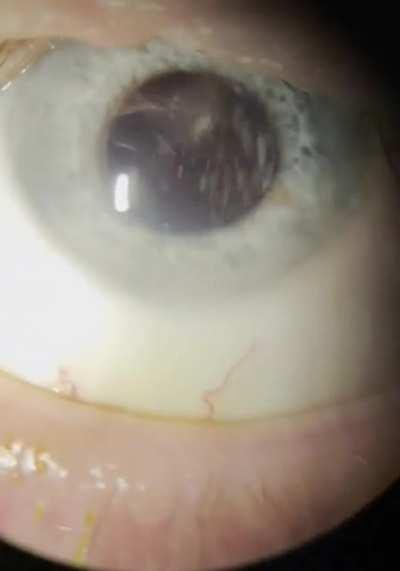 asteroid hyalosis, a condition where calcium deposits float around in your eye, making it look like a snowglobe.