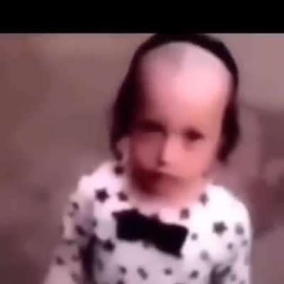 Balding 40 year old man hairline ððð