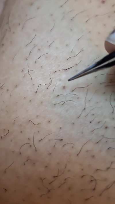 Ingrown hair