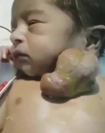 Poor baby (Ectopia Cordis: a rare congenital anomaly associated with the heart positioned outside of the thoracic cavity either partially or completely, affecting around one in 126,000 births)