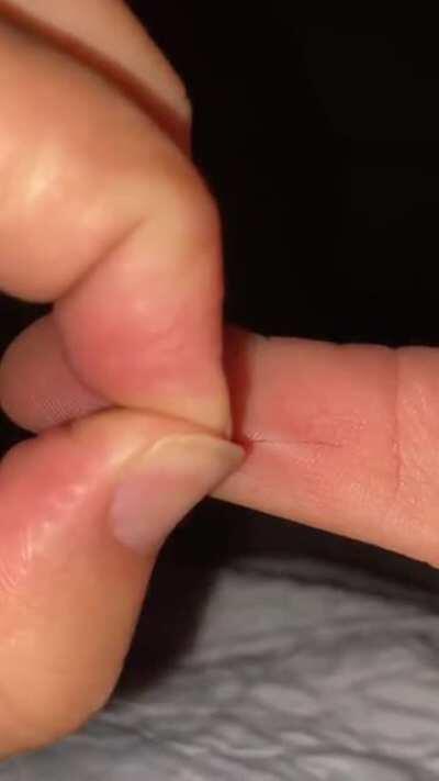 Pulled a hair out of my thumb!