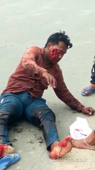 Man in shock after losing part of his eye in traffic accident