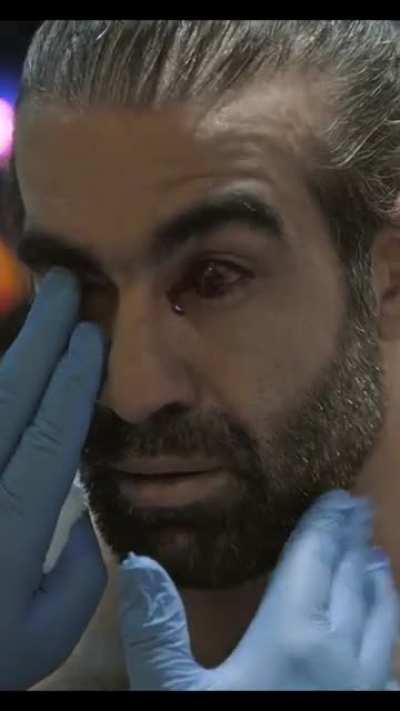 His eye looked nasty after that poke