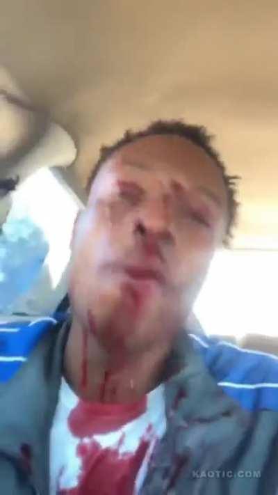 Thug Goes On Live After Getting Shot In The Face