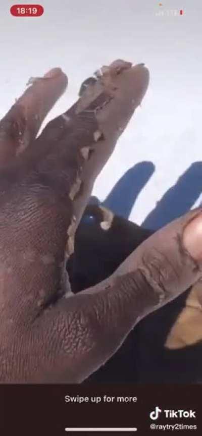 how does that much skin come off…