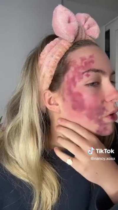 TikToker Nancy has a rare skin condition that causes random flare-ups, here is one caught on camera from the onset. This would suck so bad.