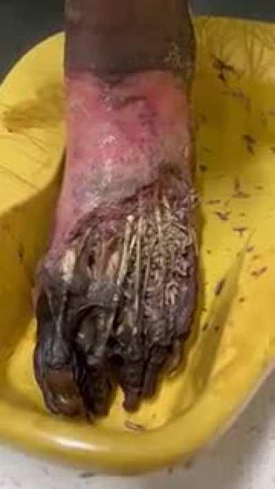 Maggots eating a man’s foot… this is fucking disgusting.