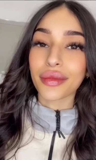 Polish woman loves her new lips