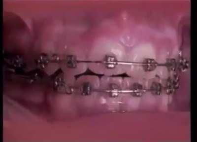 How braces work