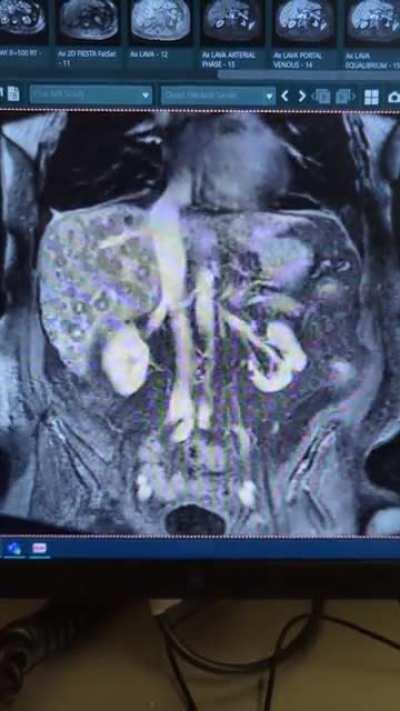 Innumerable liver masses. Oof