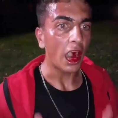 Beyler bir grup erkek kız arkadaşının yanında sen lgbt limisin diyerek darp etmişti birini onun son hali