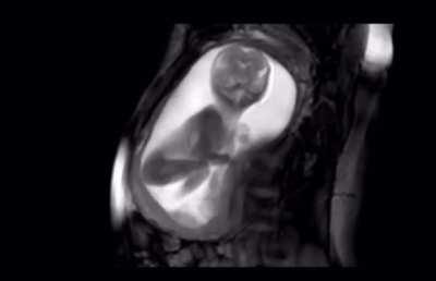 MRI footage of a 20 week old fetus stretching and kicking in womb.