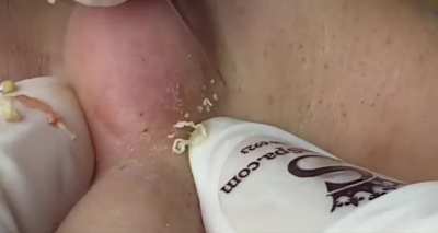 Blackheads