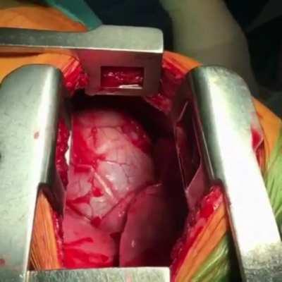 Doctors removing a knife that just missed the heart. It actually pierced the membrane of the heart wall. Warning: Open-heart surgery.