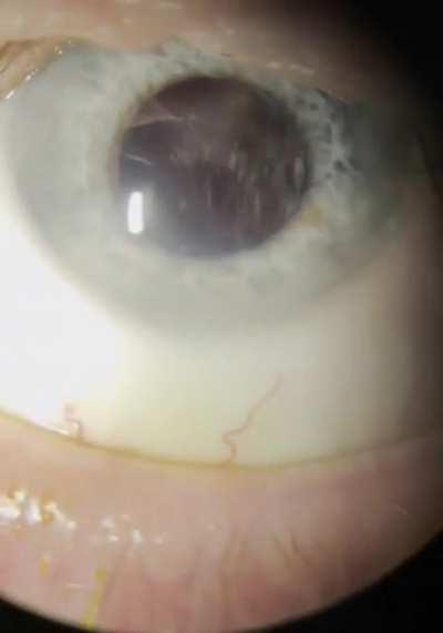 Thanks, I hate asteroid hyalosis